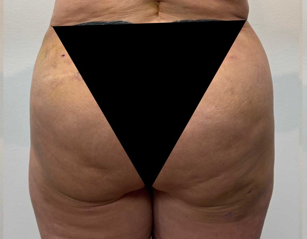 bbl before after